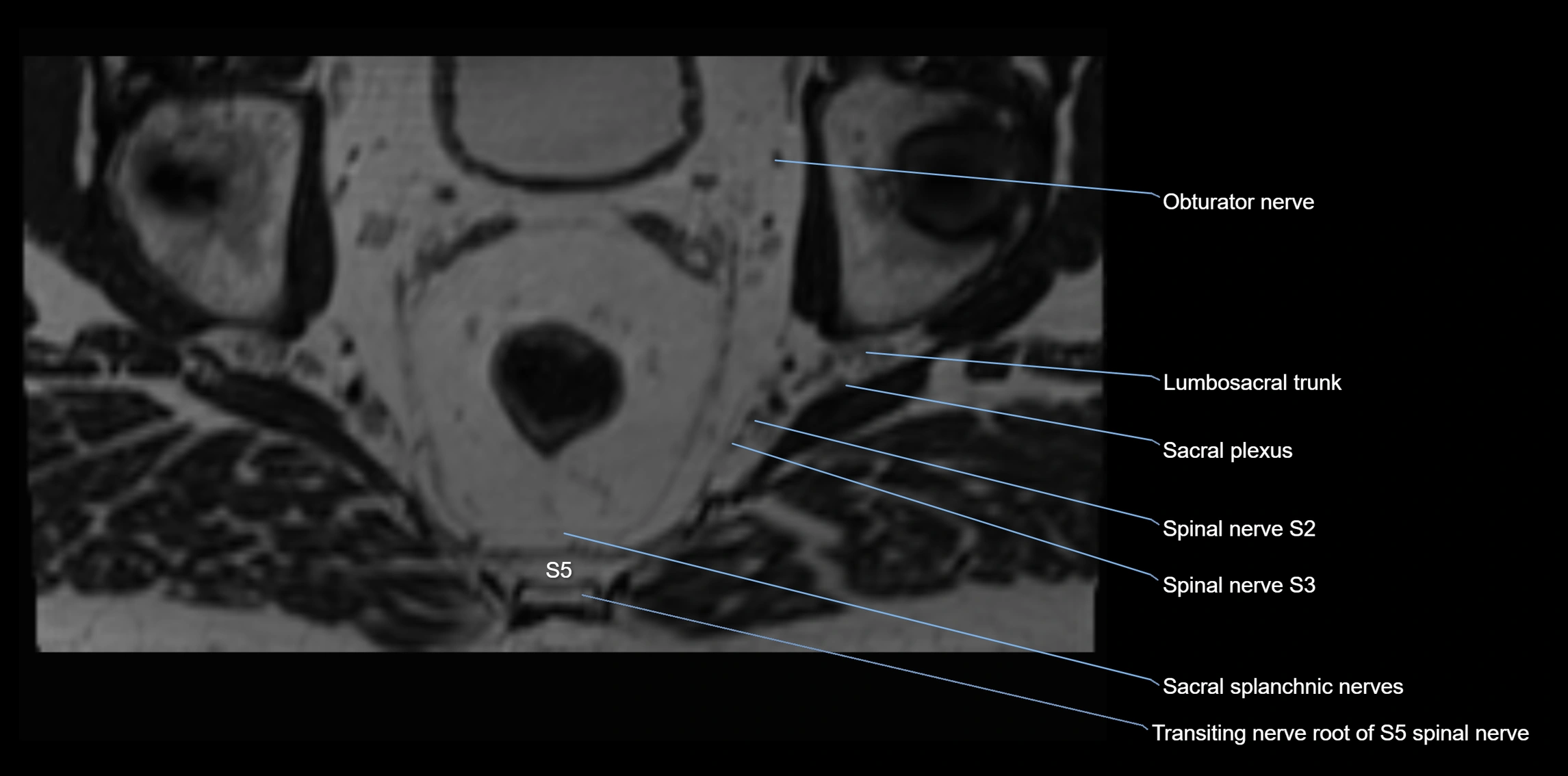 MR lumbosacral plexus axial cross sectional anatomy 3T  radiology  image-img-1008001-00110.webp